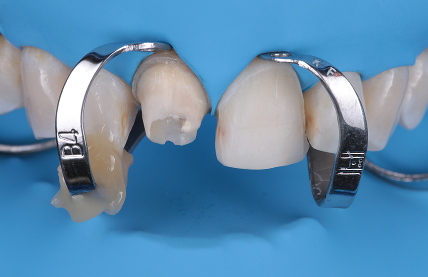 Präparationen isoliert mit Kofferdam. Bilder mit freundlicher Genehmigung von Dr. Paulo Monteiro.